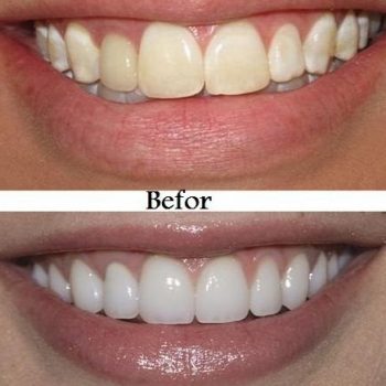 Marielaina Perrone DDS Las Vegas Porcelain Veneers